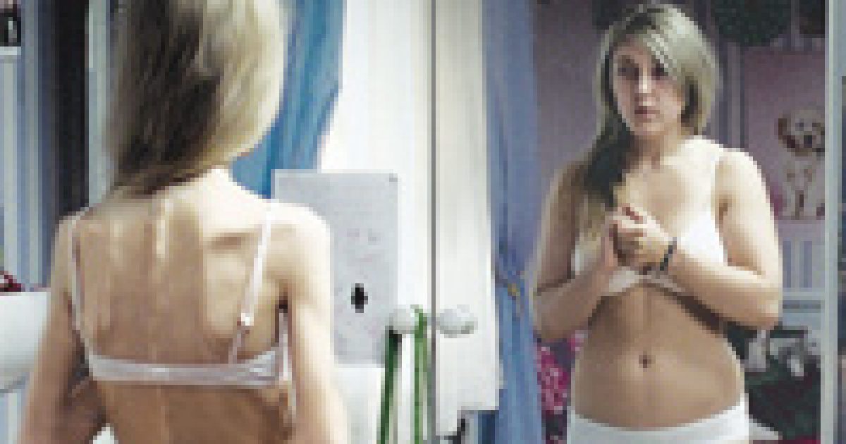 Az anorexiásnak az evés a halála