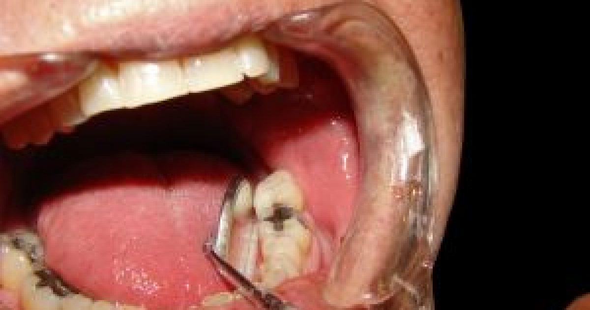A szájszag oka is lehet: a fogkő