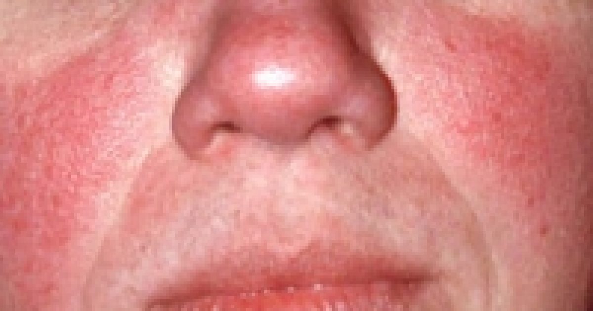 Alattomos bőrbetegség: a rosacea