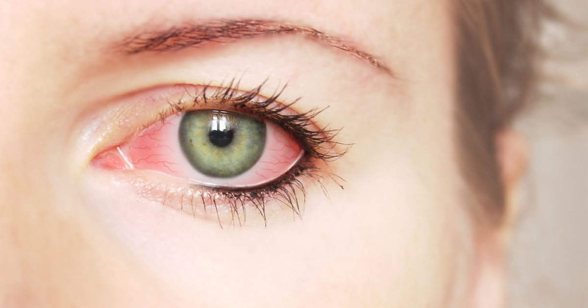 kötőhártya gyulladás szem anti aging arckezelések