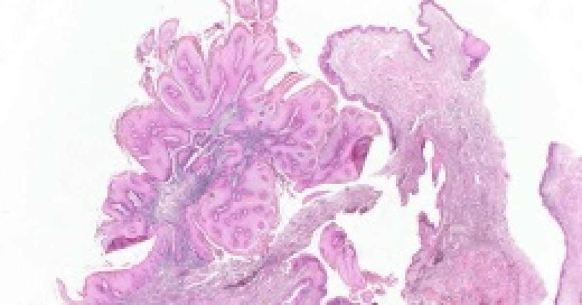 A papilloma vírus viszket és ég - HPV fertőzés tünetei férfiak esetében