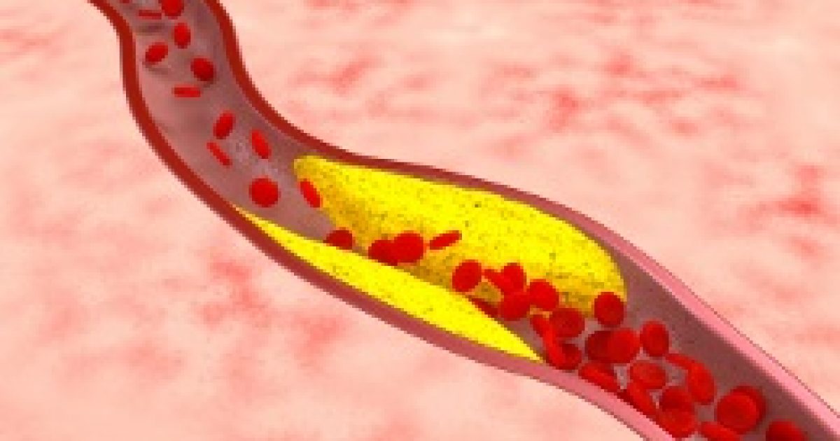 Menopauza idején nem véd a „jó” koleszterin