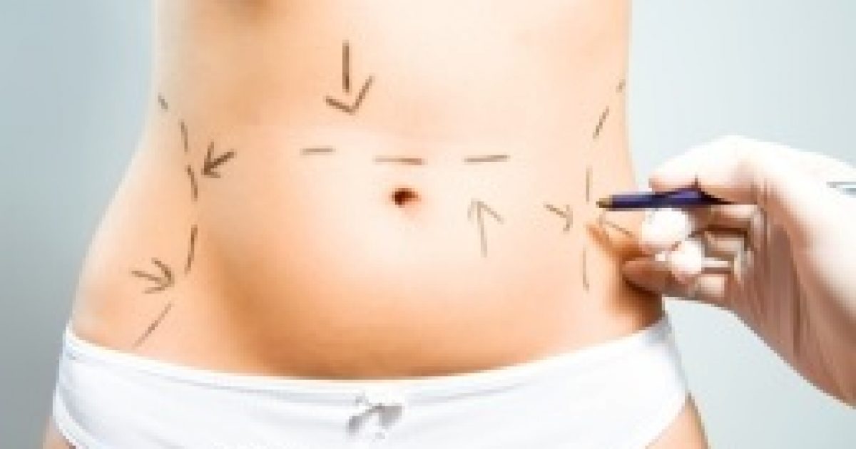 Kevés és hiányos információk a zsírleszívásról