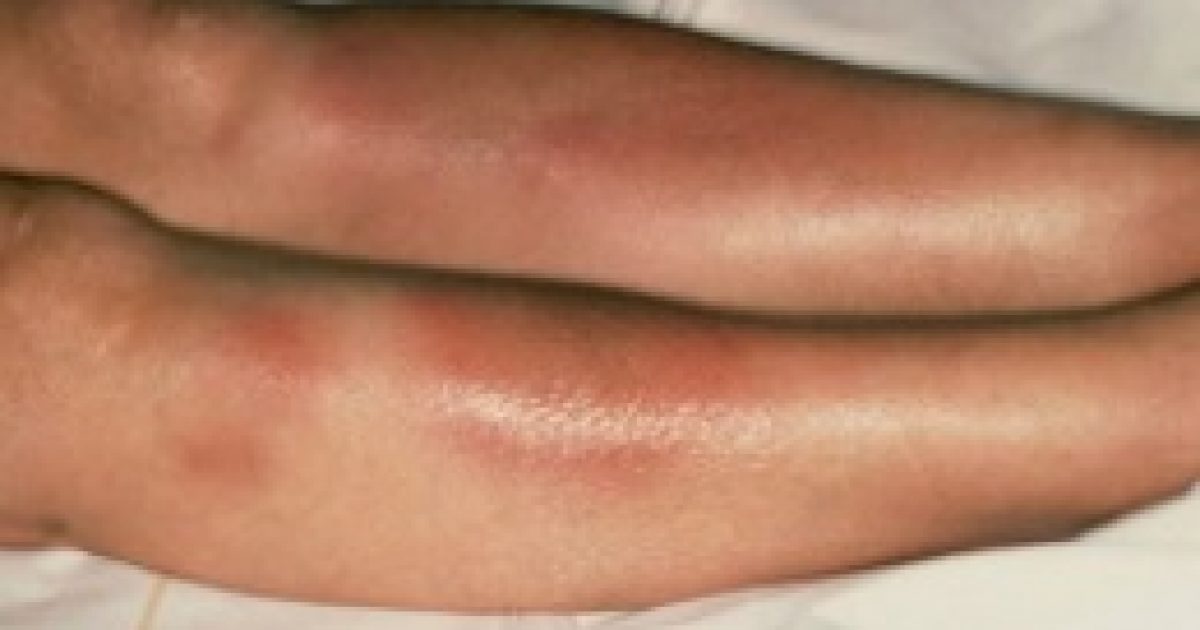 Cukorbeteg láb: hogyan gyógyulnak be a sebek?