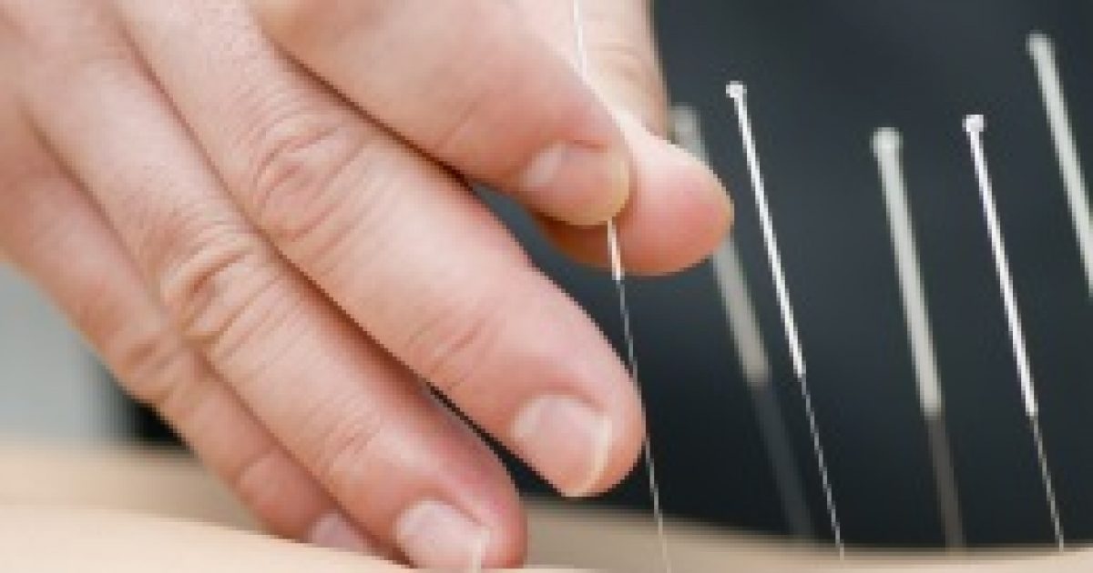 Akupunktúra segíthet a hőhullámok ellen