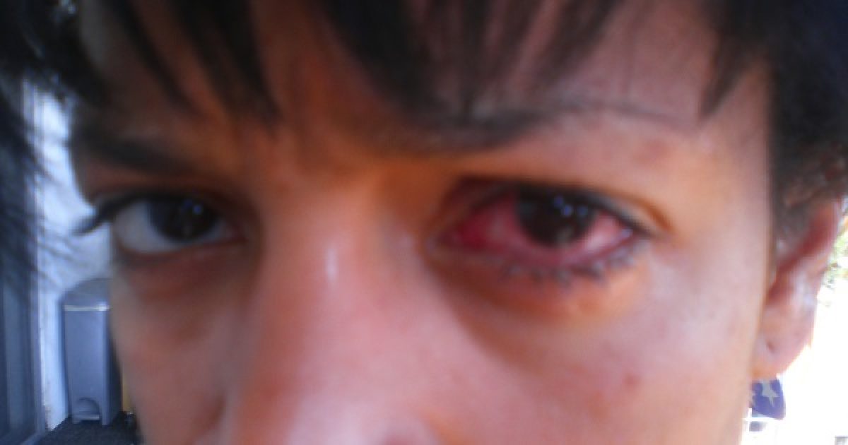 könnyező piros szem a látás zöldségekhez
