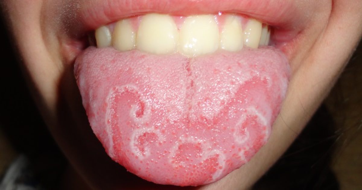 a nyelv vörös foltjai felnőtteknél kezelést okoznak