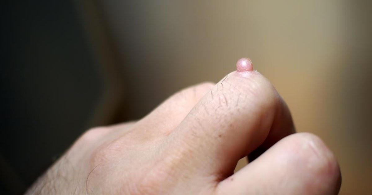 emberi bőr papillomavírus fertőzése szemölcs a láb ujján